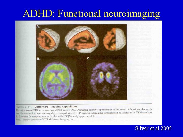 ADHD: Functional neuroimaging Silver et al 2005 