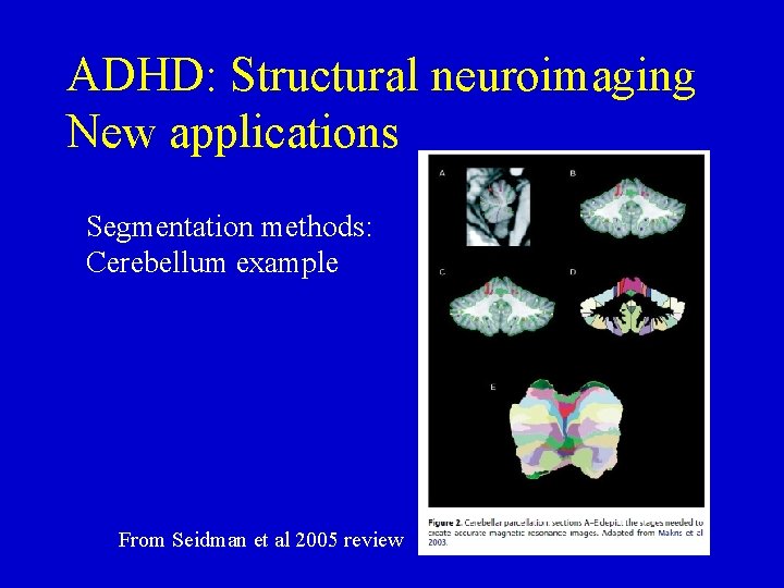 ADHD: Structural neuroimaging New applications Segmentation methods: Cerebellum example From Seidman et al 2005