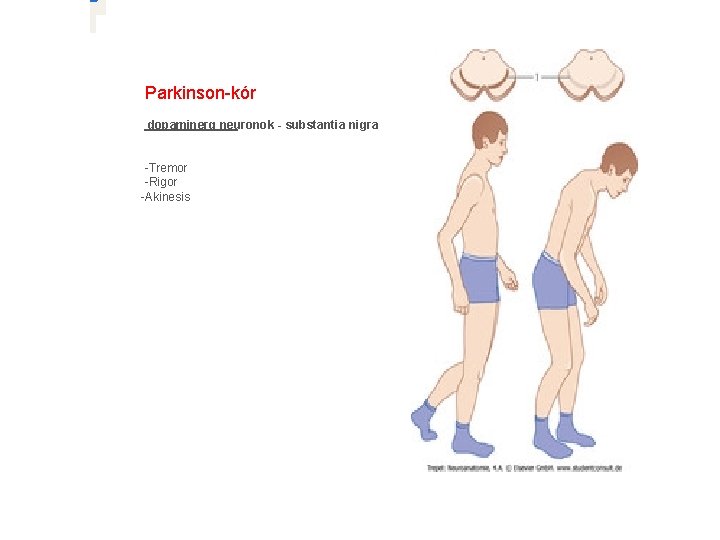 � Parkinson-kór dopaminerg neuronok - substantia nigra -Tremor -Rigor -Akinesis 