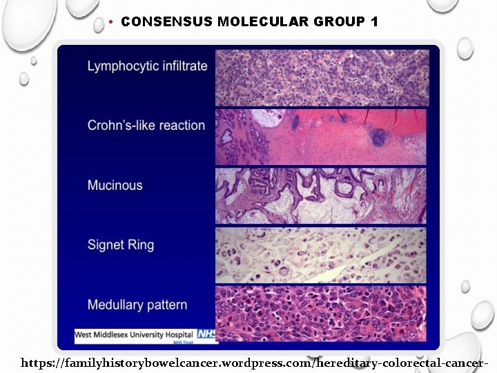  • CONSENSUS MOLECULAR GROUP 1 https: //familyhistorybowelcancer. wordpress. com/hereditary-colorectal-cancer- 