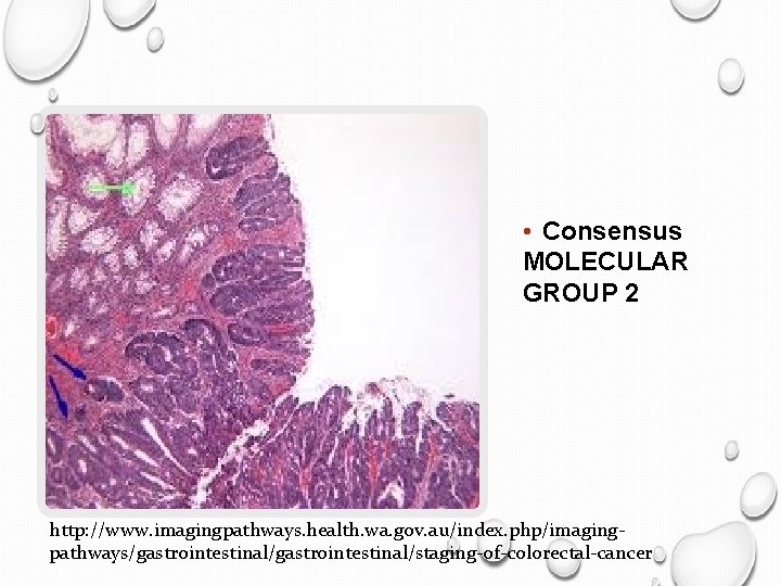  • Consensus MOLECULAR GROUP 2 http: //www. imagingpathways. health. wa. gov. au/index. php/imagingpathways/gastrointestinal/staging-of-colorectal-cancer