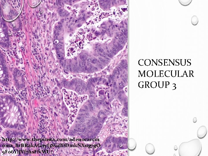 CONSENSUS MOLECULAR GROUP 3 http: //www. thepinsta. com/adenocarcin oma_8 z. BRak. AGoyf 3 SGd.