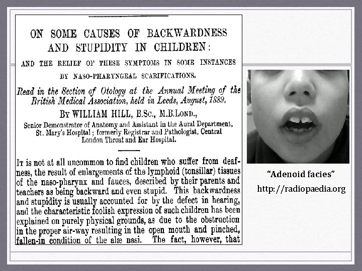 “Adenoid facies” http: //radiopaedia. org 