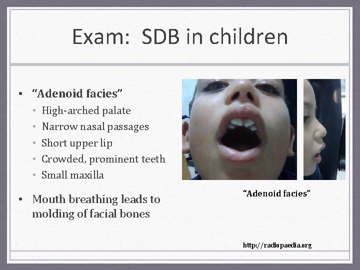 Exam: SDB in children • “Adenoid facies” • • • High-arched palate Narrow nasal