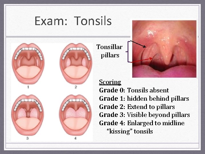 Exam: Tonsils Tonsillar pillars Scoring Grade 0: Tonsils absent Grade 1: hidden behind pillars
