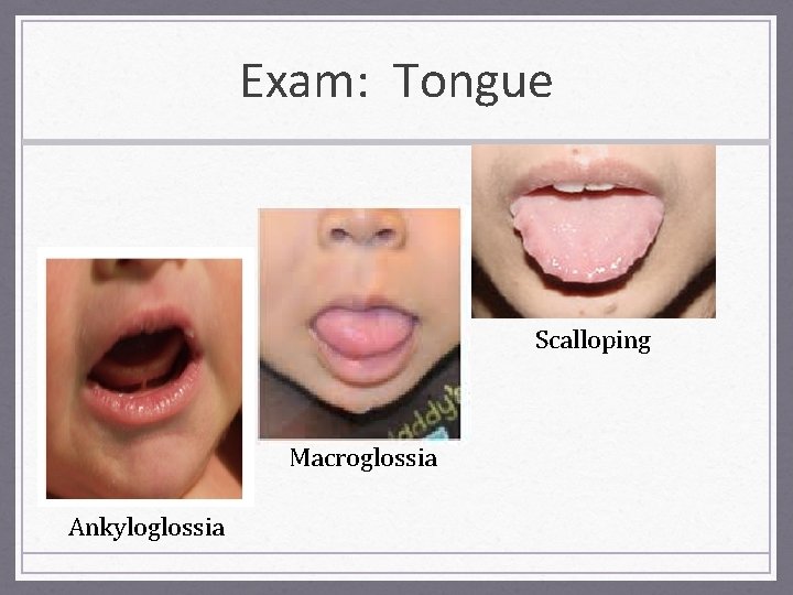 Exam: Tongue Scalloping Macroglossia Ankyloglossia 