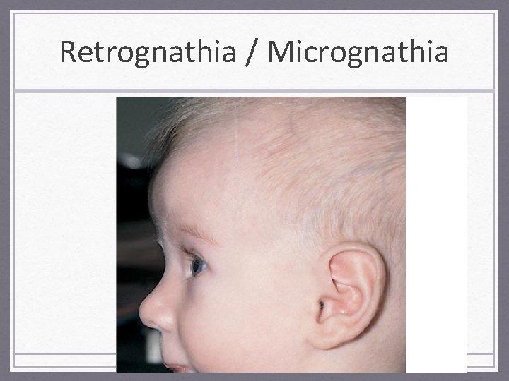Retrognathia / Micrognathia 