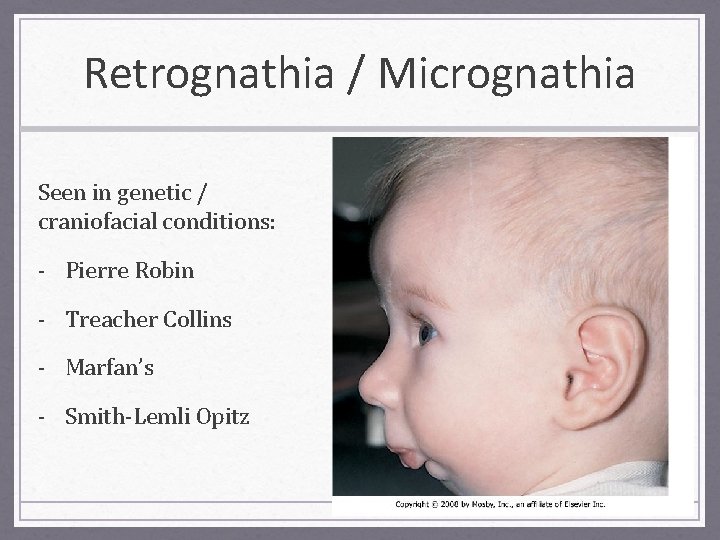 Retrognathia / Micrognathia Seen in genetic / craniofacial conditions: - Pierre Robin - Treacher