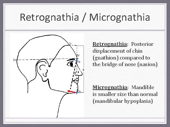 Retrognathia / Micrognathia Retrognathia: Posterior displacement of chin (gnathion) compared to the bridge of