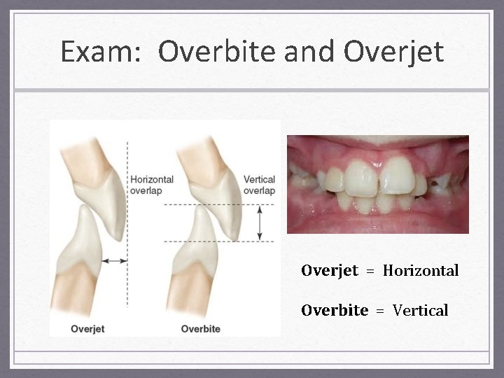 Exam: Overbite and Overjet = Horizontal Overbite = Vertical 
