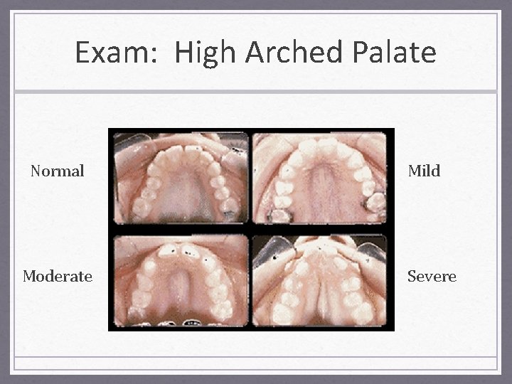 Exam: High Arched Palate Normal Moderate Mild Severe 