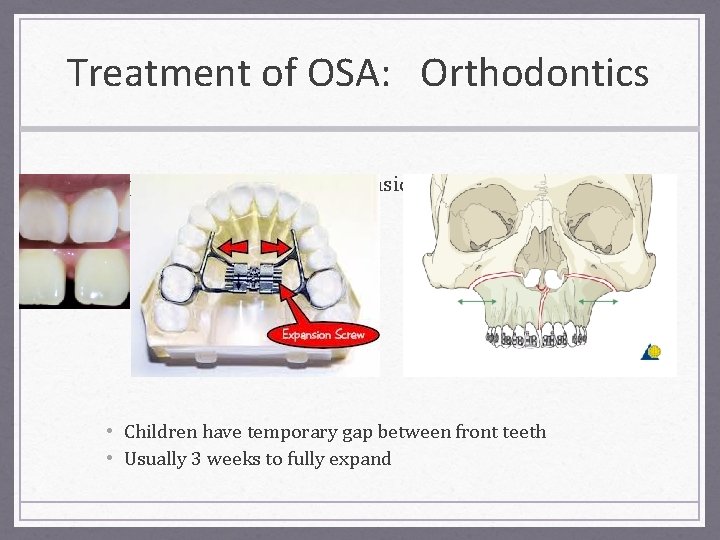 Treatment of OSA: Orthodontics • Rapid maxillary palatal expansion • Children have temporary gap