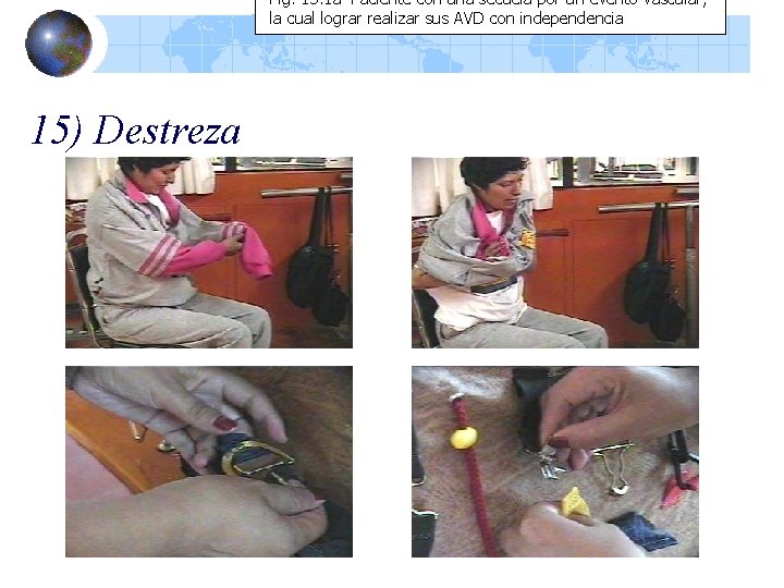 Fig. 15. 1 a Paciente con una secuela por un evento vascular, la cual