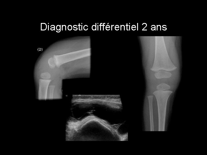 Diagnostic différentiel 2 ans 