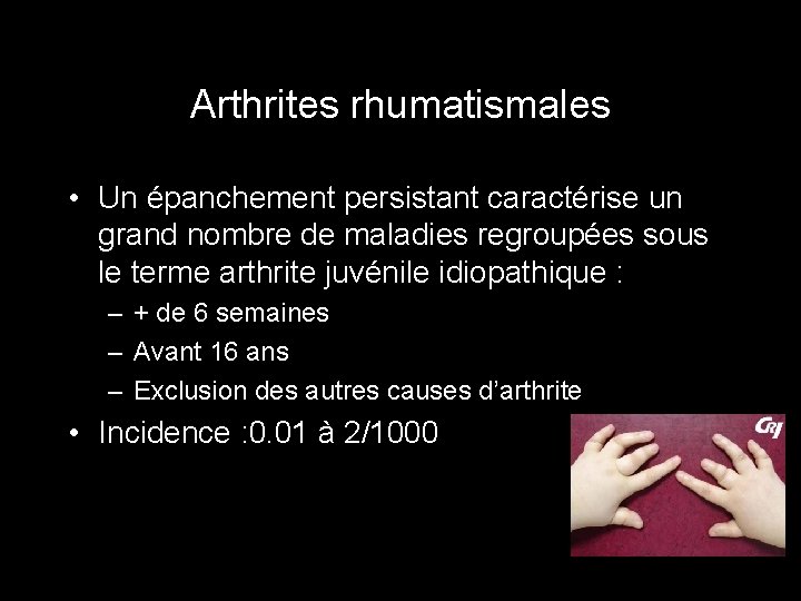 Arthrites rhumatismales • Un épanchement persistant caractérise un grand nombre de maladies regroupées sous