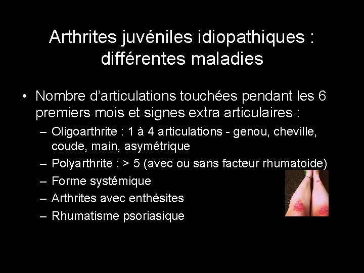 Arthrites juvéniles idiopathiques : différentes maladies • Nombre d’articulations touchées pendant les 6 premiers