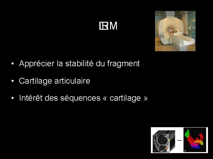  IRM � • Apprécier la stabilité du fragment • Cartilage articulaire • Intérêt