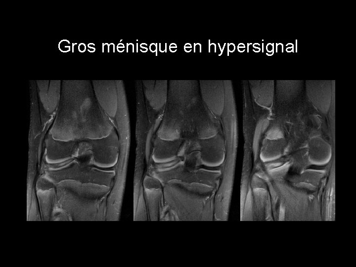 Gros ménisque en hypersignal 