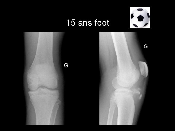 15 ans foot 