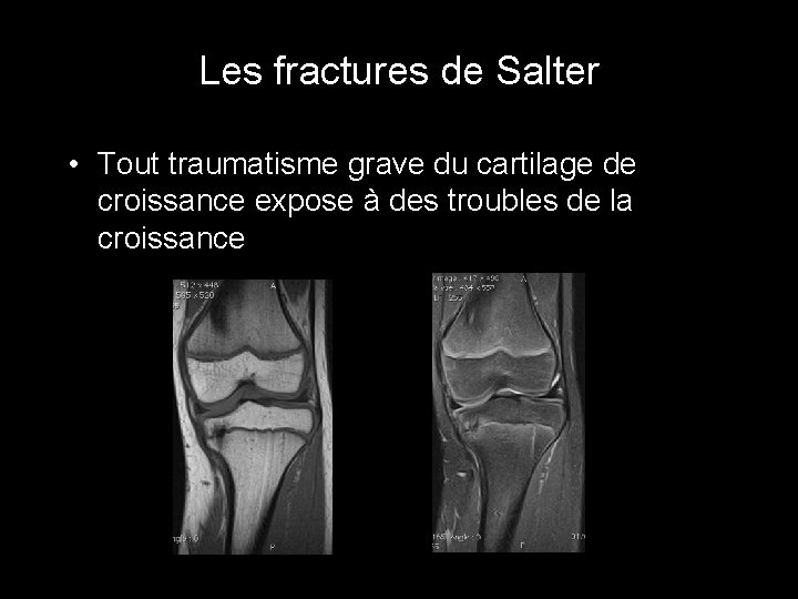Les fractures de Salter • Tout traumatisme grave du cartilage de croissance expose à