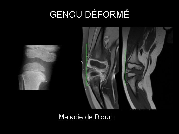 GENOU DÉFORMÉ Maladie de Blount 