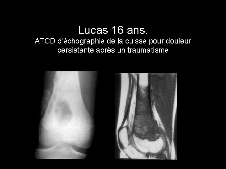 Lucas 16 ans. ATCD d’échographie de la cuisse pour douleur persistante après un traumatisme