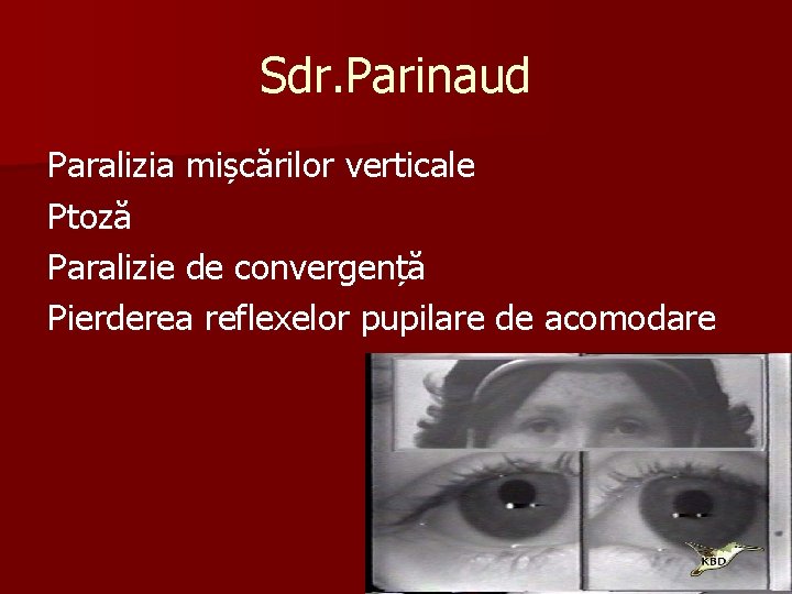 Sdr. Parinaud Paralizia mișcărilor verticale Ptoză Paralizie de convergență Pierderea reflexelor pupilare de acomodare