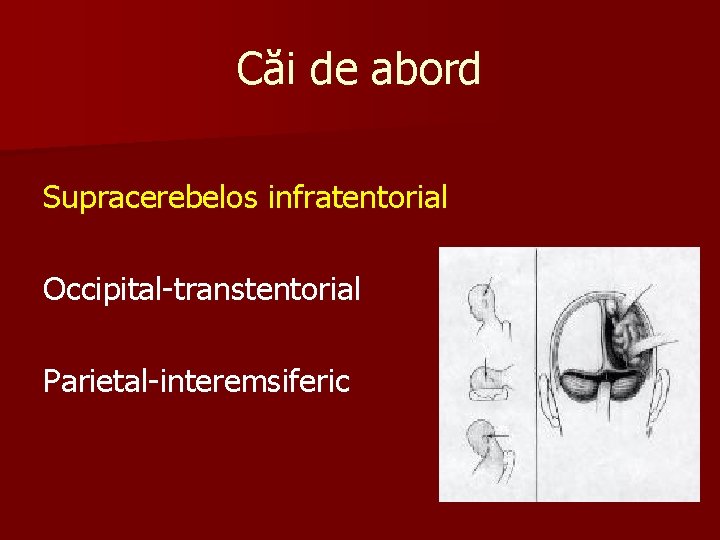 Căi de abord Supracerebelos infratentorial Occipital-transtentorial Parietal-interemsiferic 