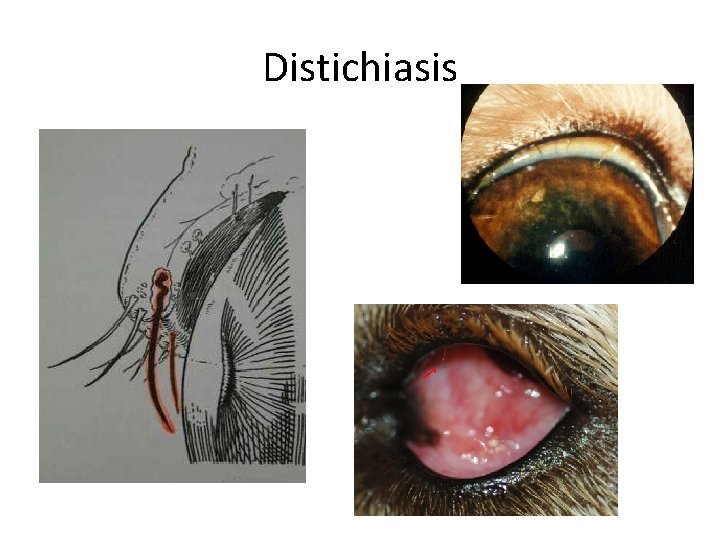 Distichiasis 