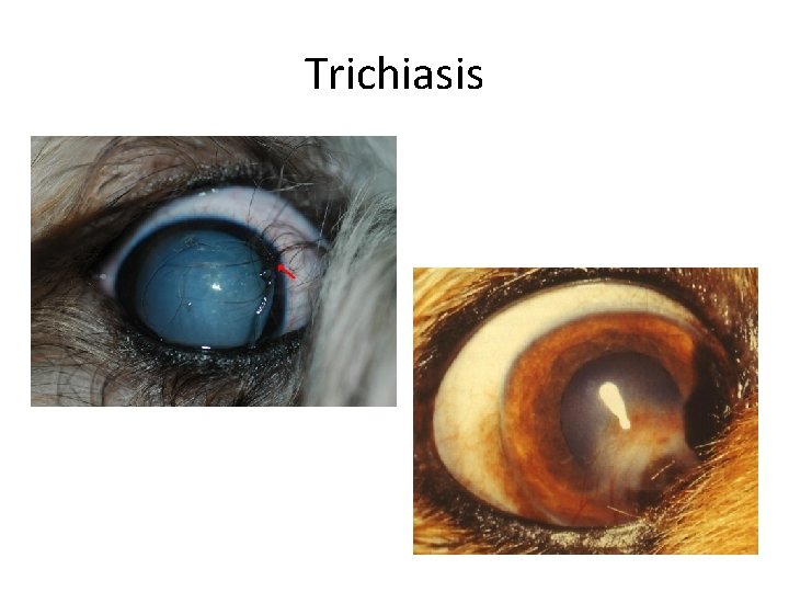 Trichiasis 