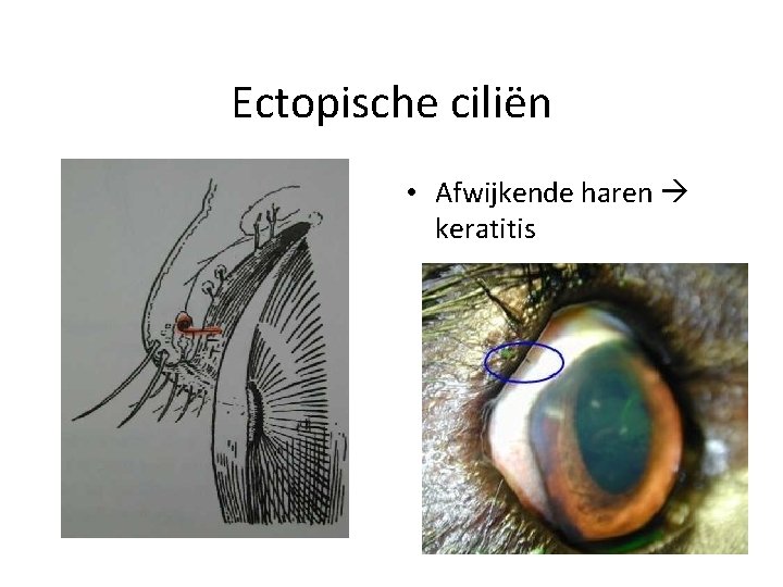 Ectopische ciliën • Afwijkende haren keratitis 