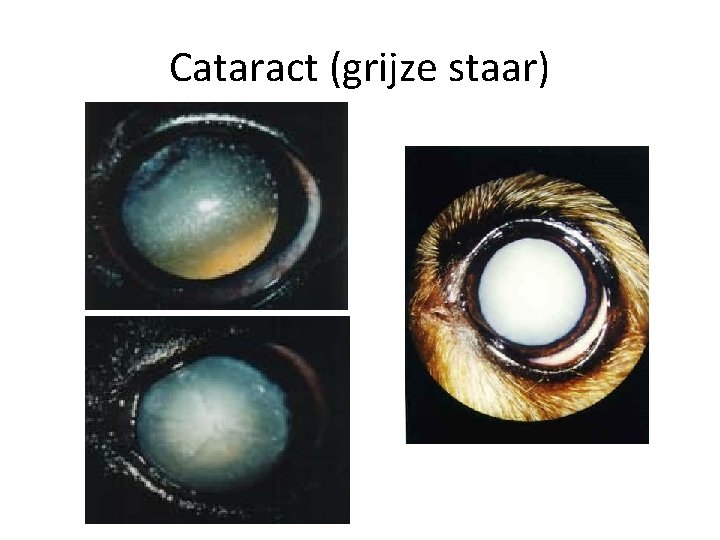 Cataract (grijze staar) 
