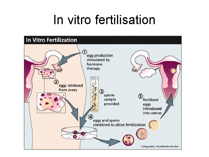 In vitro fertilisation In vitro fertilisation