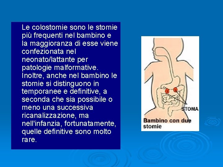Le colostomie sono le stomie più frequenti nel bambino e la maggioranza di esse