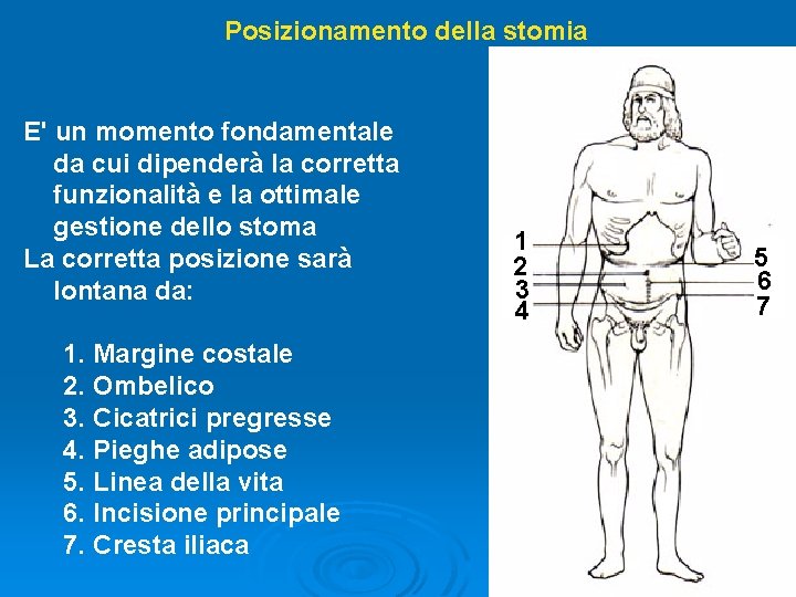 Posizionamento della stomia E' un momento fondamentale da cui dipenderà la corretta funzionalità e