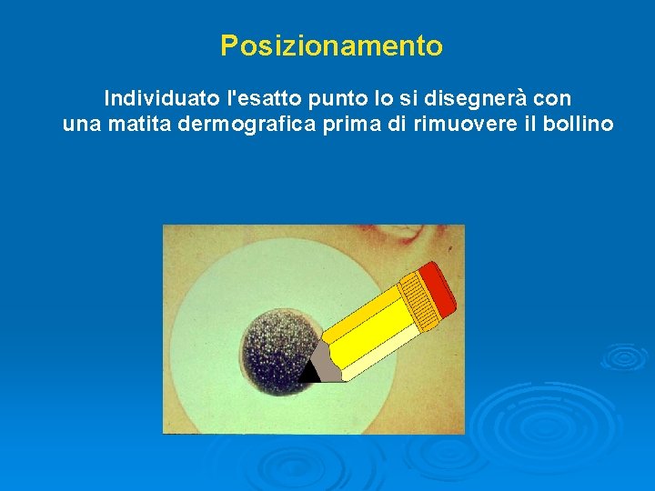 Posizionamento Individuato l'esatto punto lo si disegnerà con una matita dermografica prima di rimuovere