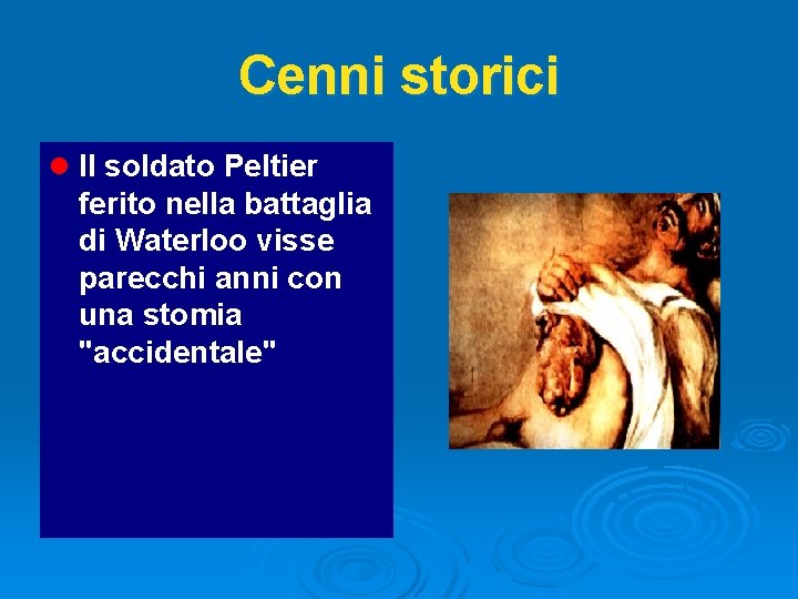 Cenni storici l Il soldato Peltier ferito nella battaglia di Waterloo visse parecchi anni