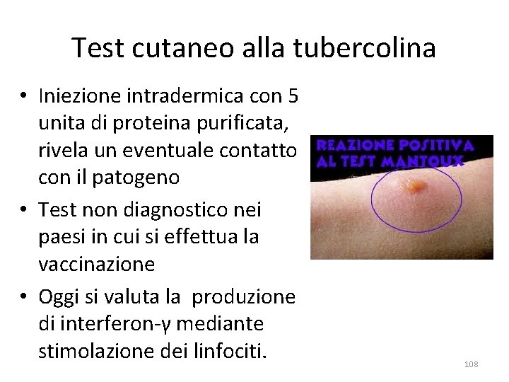 Test cutaneo alla tubercolina • Iniezione intradermica con 5 unita di proteina purificata, rivela