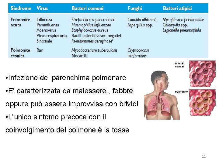  • Infezione del parenchima polmonare • E’ caratterizzata da malessere , febbre oppure