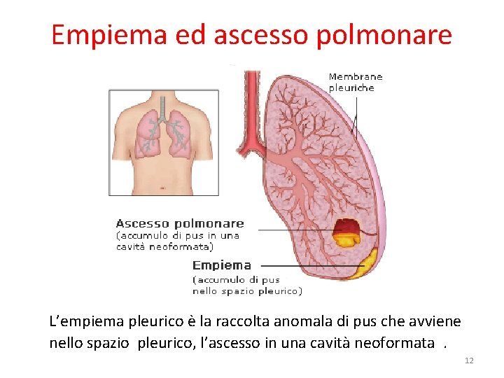 Empiema ed ascesso polmonare L’empiema pleurico è la raccolta anomala di pus che avviene