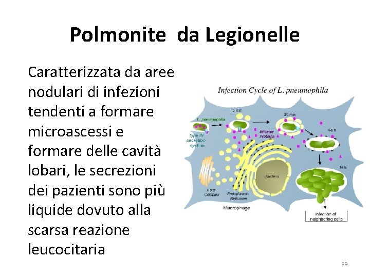 Polmonite da Legionelle Caratterizzata da aree nodulari di infezioni tendenti a formare microascessi e