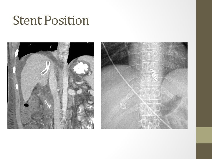 Stent Position 