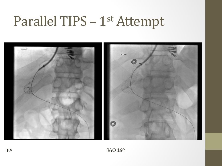 Parallel TIPS – 1 st Attempt PA RAO 19 o 