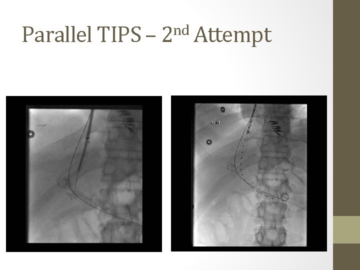 Parallel TIPS – 2 nd Attempt 