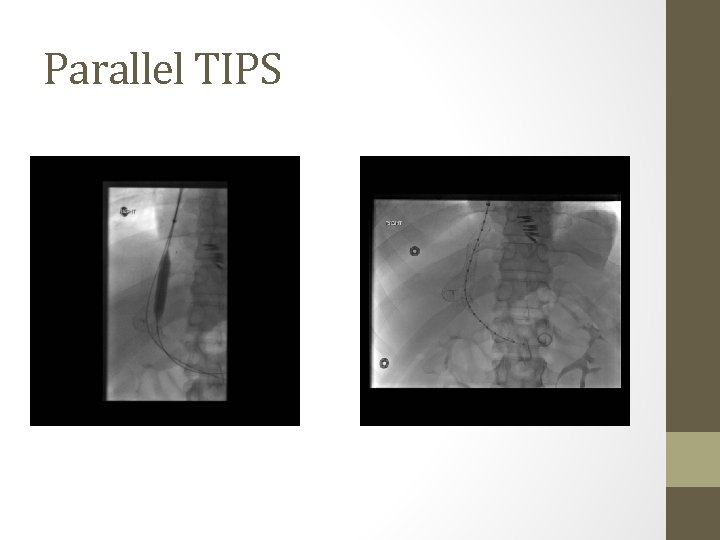 Parallel TIPS 