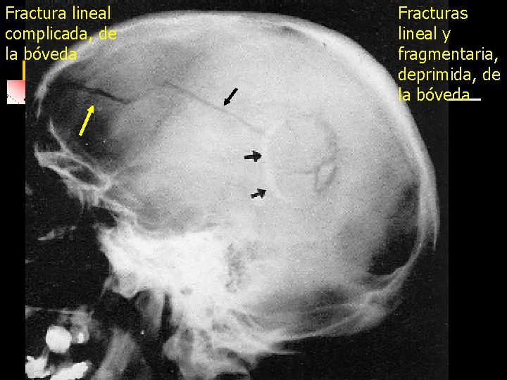 Fractura lineal complicada, de la bóveda Fracturas lineal y fragmentaria, deprimida, de la bóveda