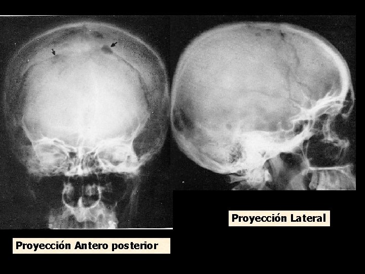 Proyección Lateral Proyección Antero posterior 