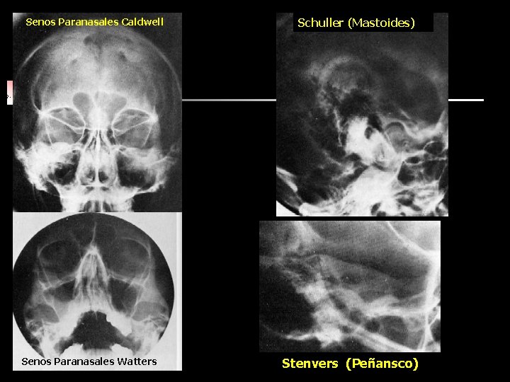 Senos Paranasales Caldwell Senos Paranasales Watters Schuller (Mastoides) Stenvers (Peñansco) 