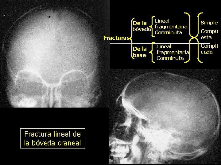 Lineal fragmentaria bóveda Conminuta De la Fracturas De la base Fractura lineal de la