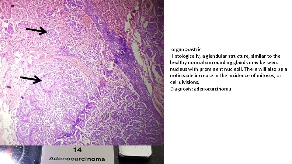 organ: Gastric Histologically, a glandular structure, similar to the healthy normal surrounding glands may